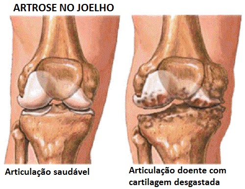 Diferenças entre artrite, artrose e osteoporose