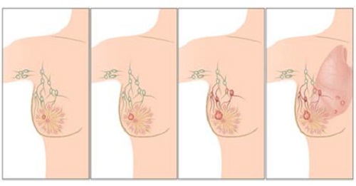 Principais causas do câncer de mama que você deveria conhecer