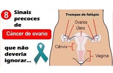 8 sinais precoces de câncer de ovário