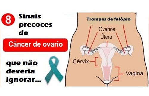 8 sinais precoces de câncer de ovário
