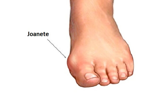 eliminar os joanetes