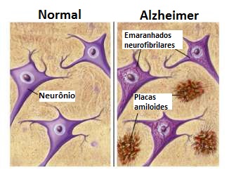 Neurônios com mal de Alzheimer