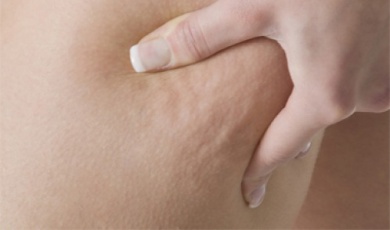 Celulite: 3 infusões medicinais muito eficazes para combatê-la!