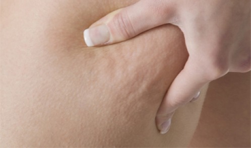 Celulite: 3 infusões medicinais muito eficazes para combatê-la!