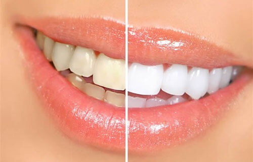 Dentes-amarelos-500x321