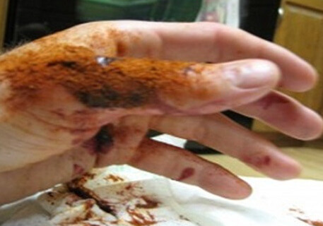 Um gel capaz de parar os sangramentos em 10 segundos Um gel capaz de parar os sangramentos em 10 segundos