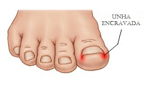unhas encravadas