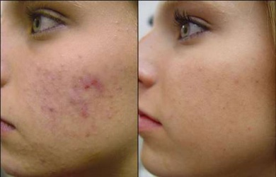 4 máscaras caseiras antiacne