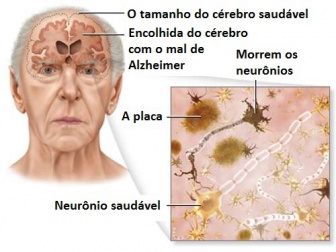 Dicas que podem reduzir o risco do mal de Alzheimer