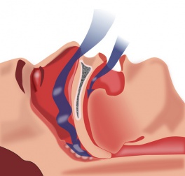 Tratamento natural para a apneia do sono