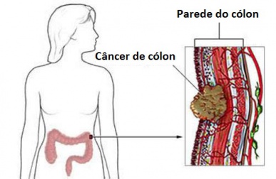 Sintomas do câncer colorretal em mulheres