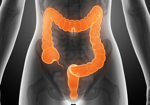 colon irritado