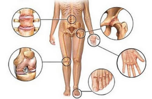 Ilustração do corpo humano e das dores nos braços e nas pernas