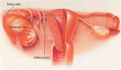 Sintomas da doença inflamatória pélvica (DIP) na mulher