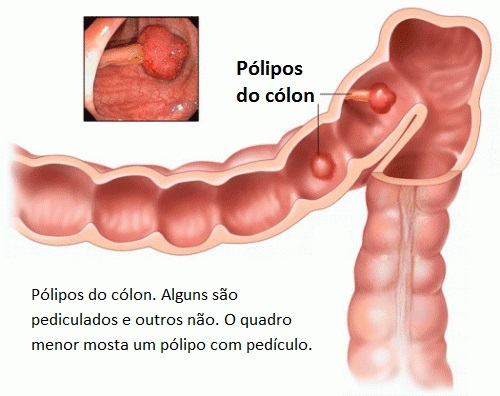 polipos