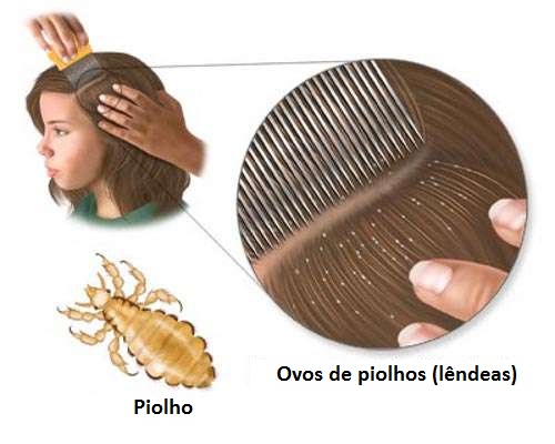 5 remédios caseiros para combater os piolhos - Melhor com Saúde