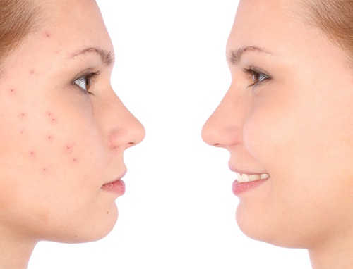 água com vinagre de maçã para acabar com a acne
