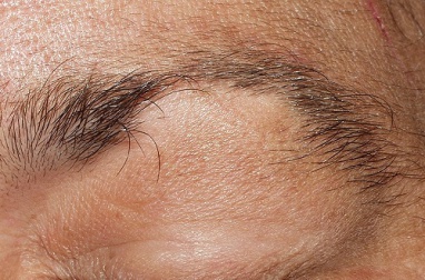 Alopecia em sobrancelhas e cílios: que tratamento seguir?
