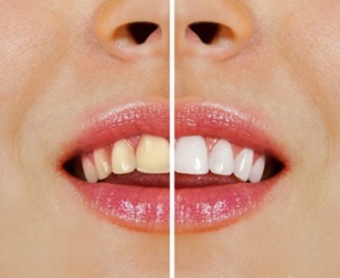 Cuidado! Alimentos que amarelam os dentes, como combatê-los?