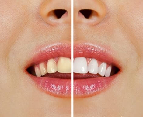 Clarear os dentes com sal