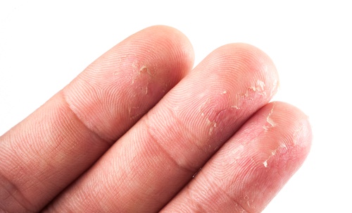 Não beber água suficiente pode causar eczema