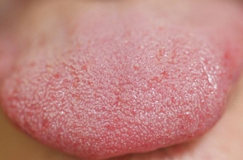 Lingua-amarela-a-que-se-deve-500x330