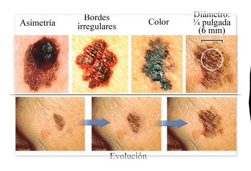 O melanoma: como indicar seus primeiros indícios