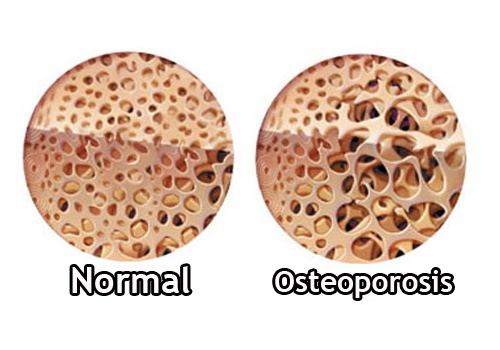 Osteoporose_-500x350
