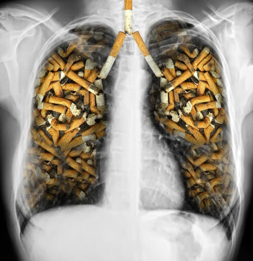 Câncer de pulmão pelo cigarro