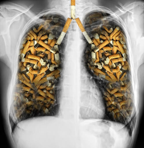 Câncer de pulmão pelo cigarro