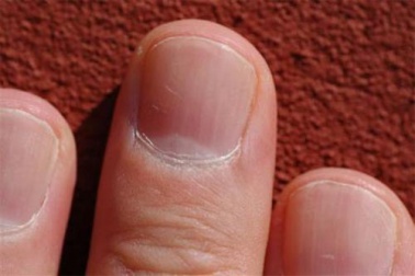 Você sabia que o estado das unhas pode dizer muito sobre a sua saúde?