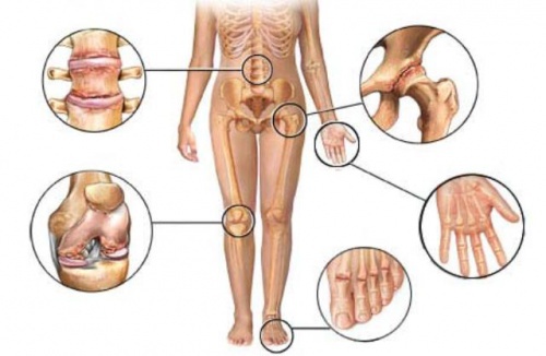 Diferenças entre artrite, artrose e osteoporose que valem a pena conhecer