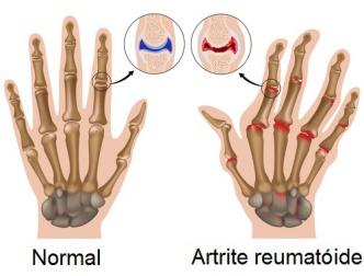 7 passos para superar a artrite reumatoide