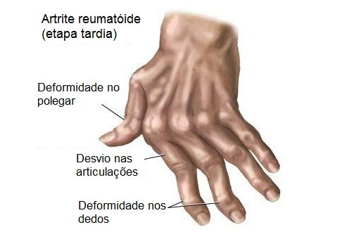 7 remédios naturais para a artrite nas mãos