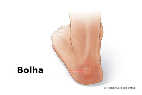 bolhas nos pés