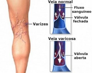 10 remédios herbais contra as varizes