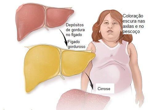 Gordura no fígado: quais são os sintomas?