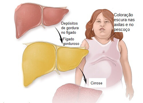 Gordura no fígado: quais são os sintomas? - Melhor com Saúde