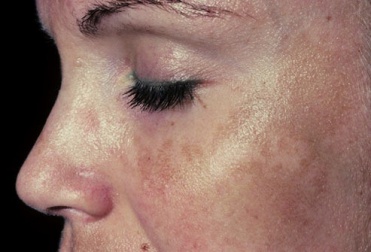 6 remédios naturais para atenuar o melasma