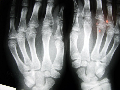 osteoartrite