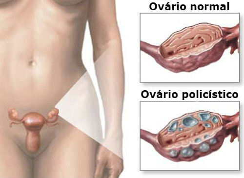Tratamento natural para a Síndrome do Ovário Policístico Tratamento natural para a Síndrome do Ovário Policístico