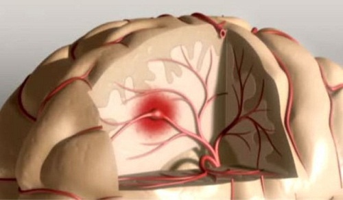Icto: é possível preveni-lo ou detectá-lo a tempo?
