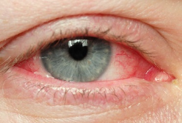 Olhos irritados - Dicas naturais para esse problema