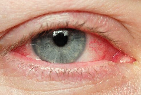 Olhos irritados - Dicas naturais para esse problema