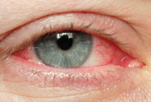 Dicas naturais para tratar olhos irritados Dicas naturais para tratar olhos irritados