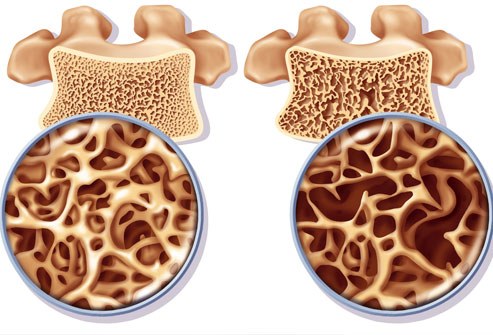 Exercícios para prevenir e tratar a osteoporose Exercícios para prevenir e tratar a osteoporose