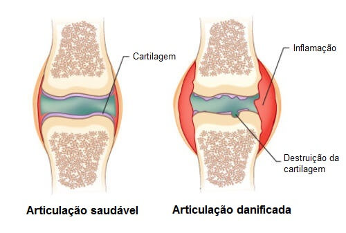 dacă articulațiile genunchiului sunt foarte dureroase care tratează artrita în clinică