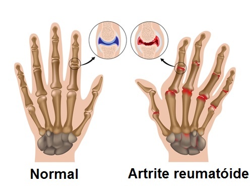 artrite1