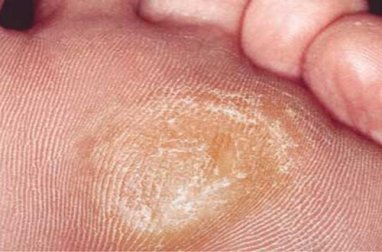 7 remédios caseiros para os calos nos pés