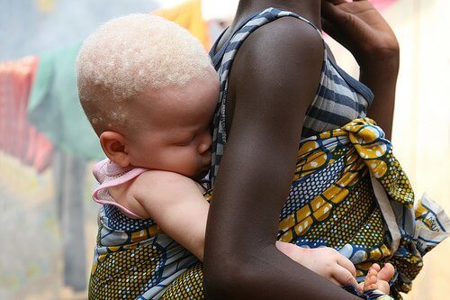 A maldição de ser albino na África
